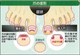 足の爪トラブル予防
