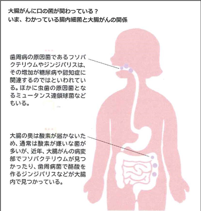 大腸がんと歯周病菌との関係